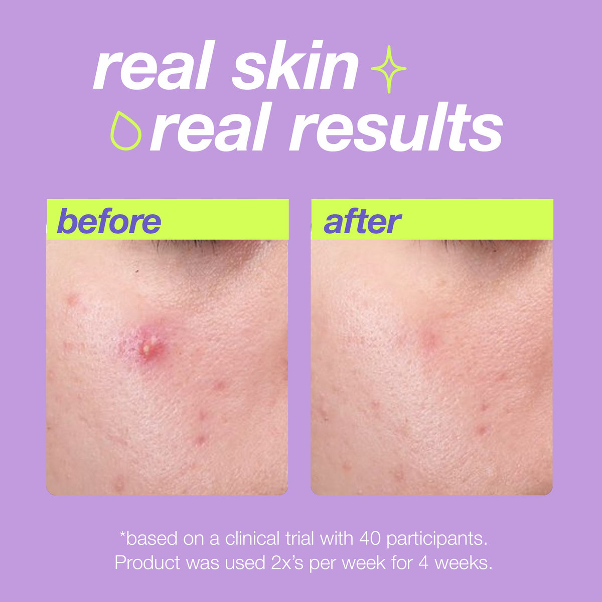 breakout clearing liquid peel